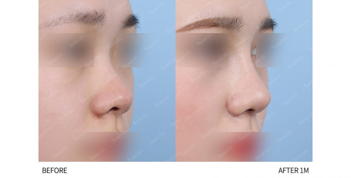 Slider image (6) 1mm Plastic Surgery